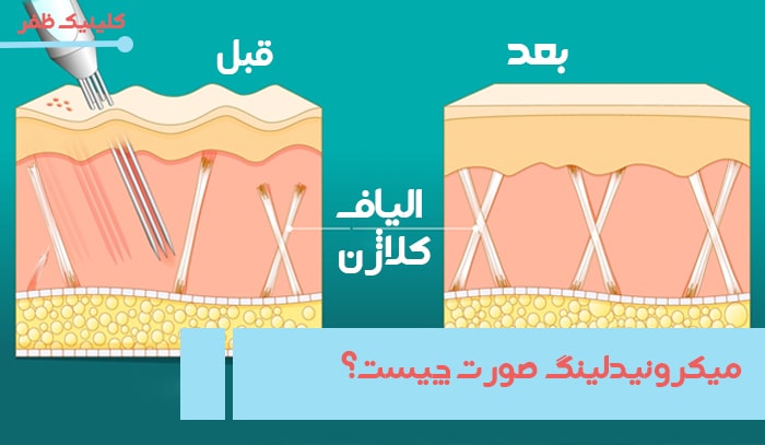 http://میکرونیدلینگ%20چیست؟