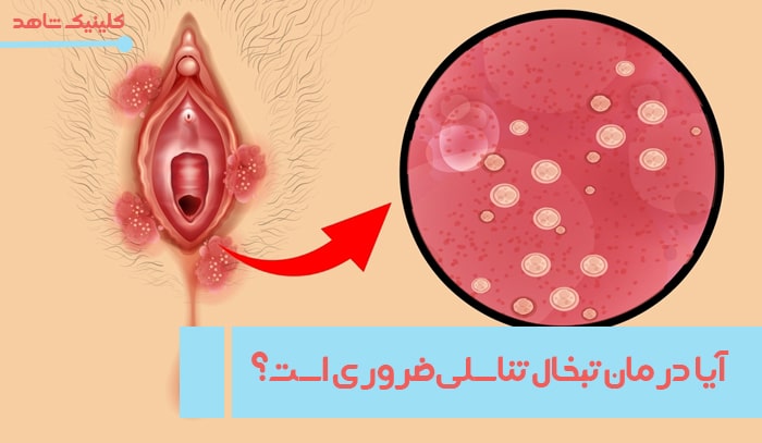 درمان تبخال تناسلی ضروری است؟