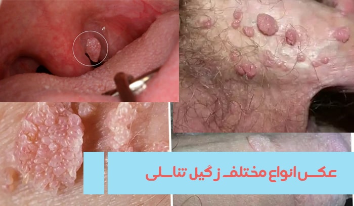http://انواع%20زگیل%20تناسلی
