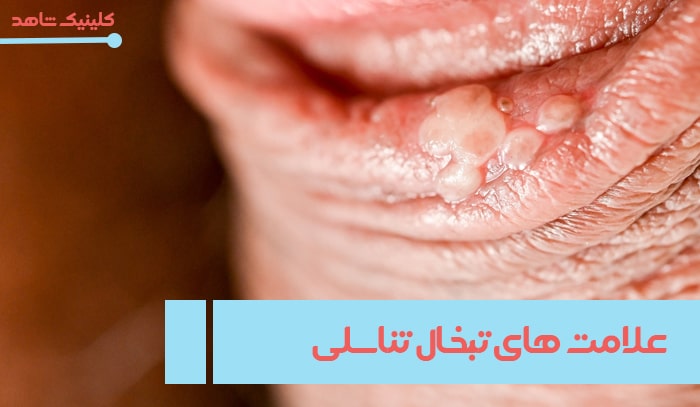 علامت‌های تبخال تناسلی