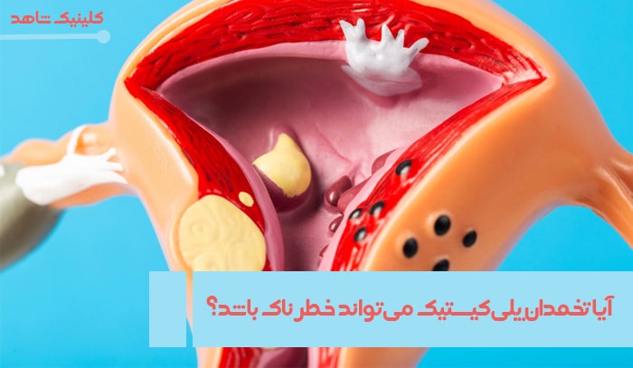آیا تخمدان پلی‌کیستیک می‌تواند خطرناک باشد؟