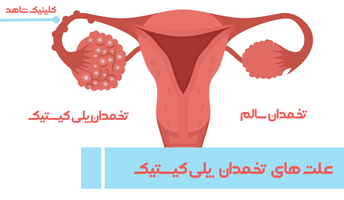 علت‌های تخمدان پلی کیستیک