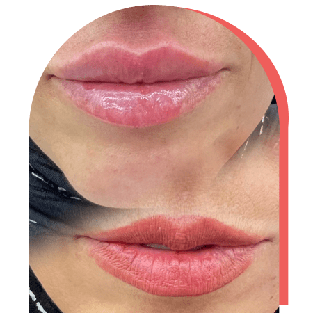 http://نمونه%20کار%20تزریق%20ژل%20لب%20روسی