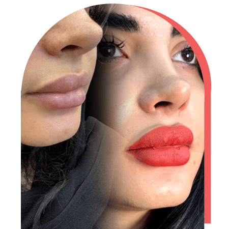 http://نمونه%20کار%20زیبایی%20فیلر%20لب