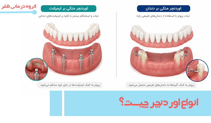 http://انواع%20اوردنچر
