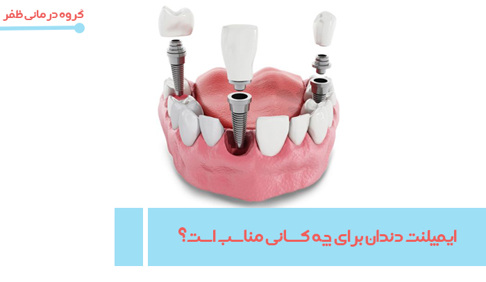 http://ایمپلنت%20دندان%20برای%20چه%20کسانی%20مناسب%20است؟