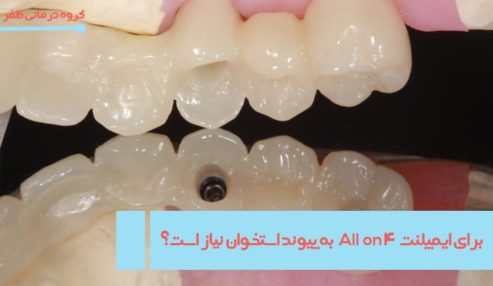 http://آیا%20برای%20ایمپلنت%20All%20on%20۴%20به%20پیوند%20استخوان%20نیاز%20است؟