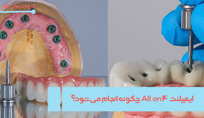 http://ایمپلنت%20All%20on%20۴%20چگونه%20انجام%20می%20شود؟