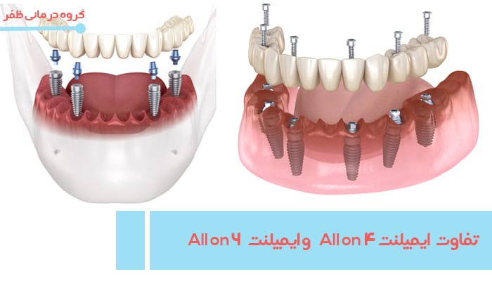 http://تفاوت%20هزینه%20All%20on%20۴%20و%20All%20on%20۶