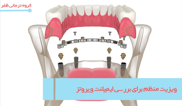 http://اهمیت%20مراجعه%20منظم%20برای%20بررسی%20ایمپلنت%20و%20پروتز